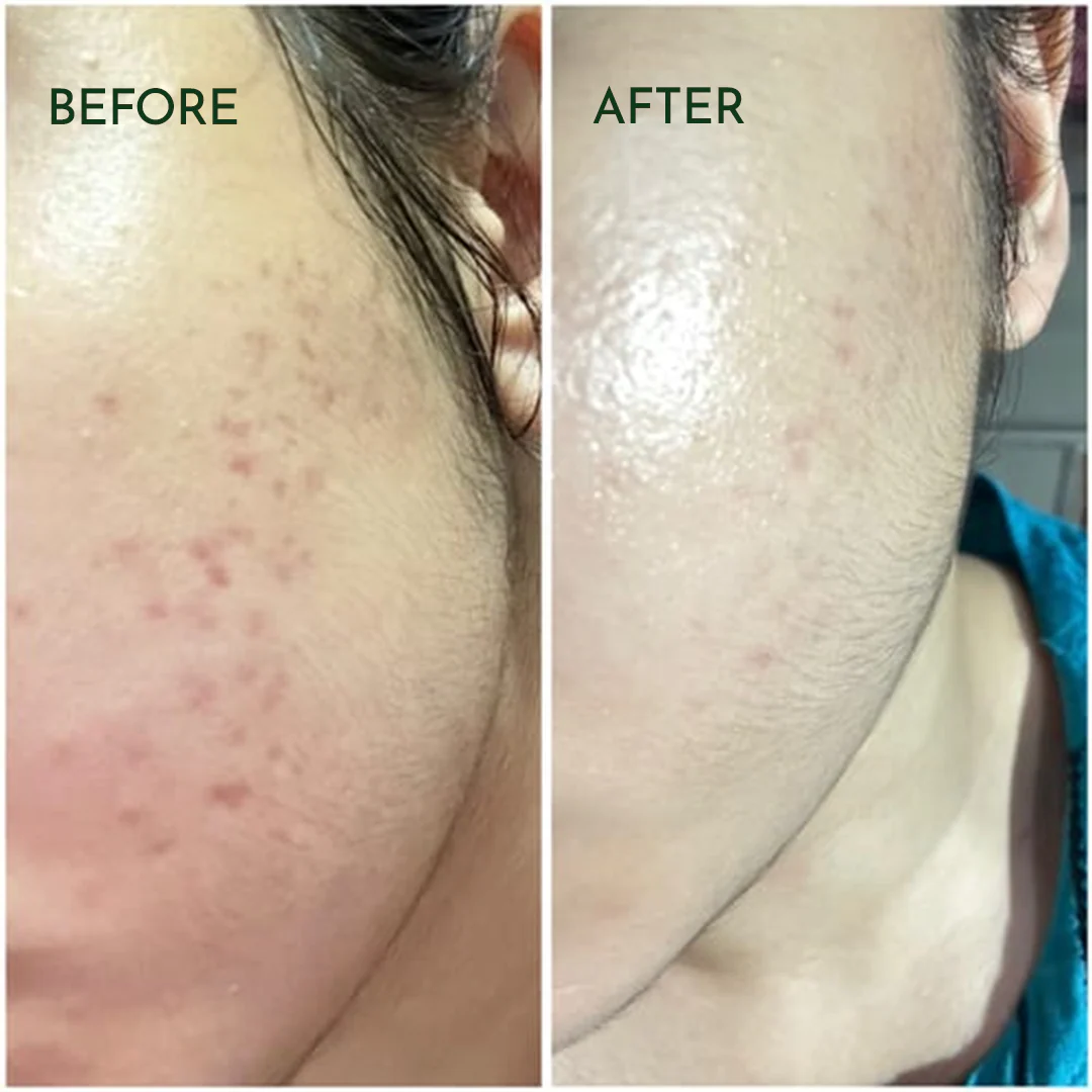 ACNE CLARIFYING SERUM - Energetic Skin Therapy for Acne & Scars - Image 4
